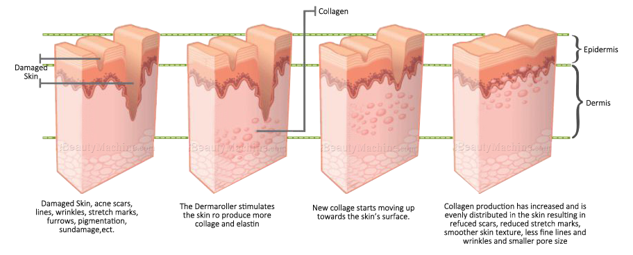 Derma Needling system needle derma roller