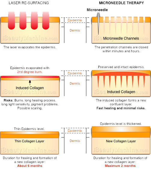 Dermaroller vs Laser Treatment