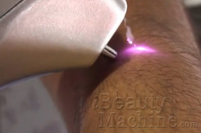 Laser treatment