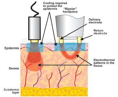 Advanced RF Facial And Body Shaping Therapy For Bipolar And