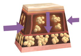 multipolar rf machine