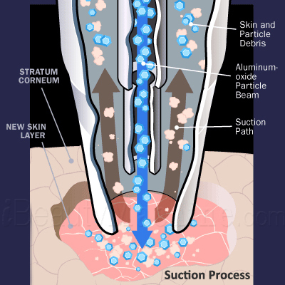 Diamond Dermabrasion Suction process