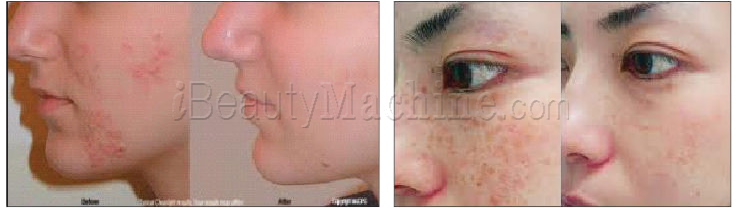 laser diode treatment before and after