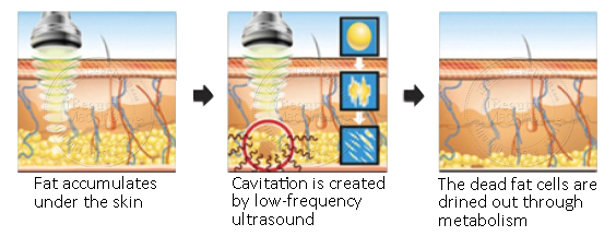 The Effects of Low-Intensity Ultrasound Cavitation on Unwanted Fat - Cutera  Aesthetics