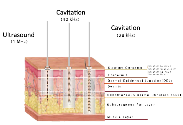 Ultrasonic Cavitation  Best Method To Remove Fat