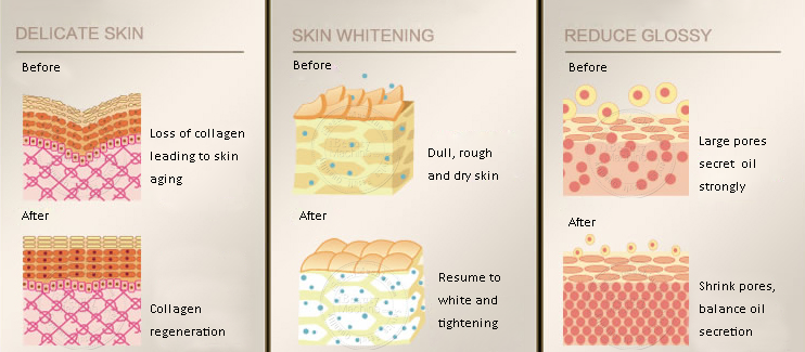 Monopolar RF treatment on skin