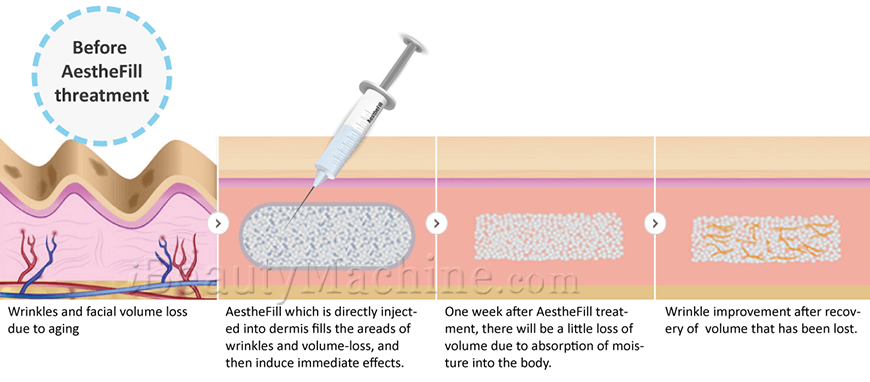 Aesthefill Poly-lactic Acid Dermal Filler