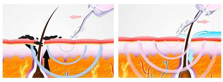 Ultrasound Peeling