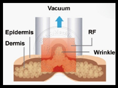 Vacuum slimming cavitation machine