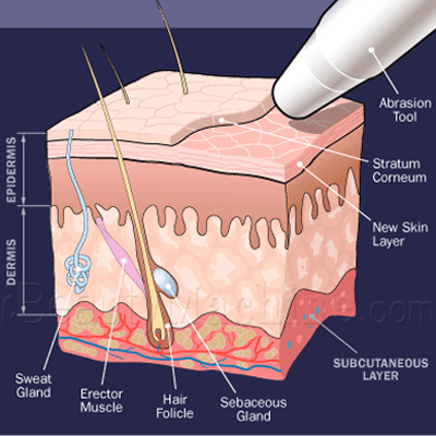 Diamond Dermabrasion working principle