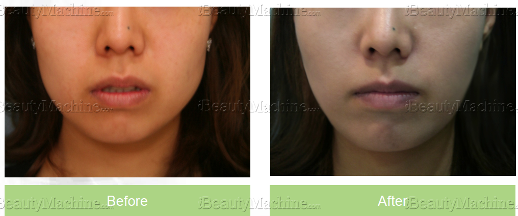 Face Lifting with 3D Barbed Thread