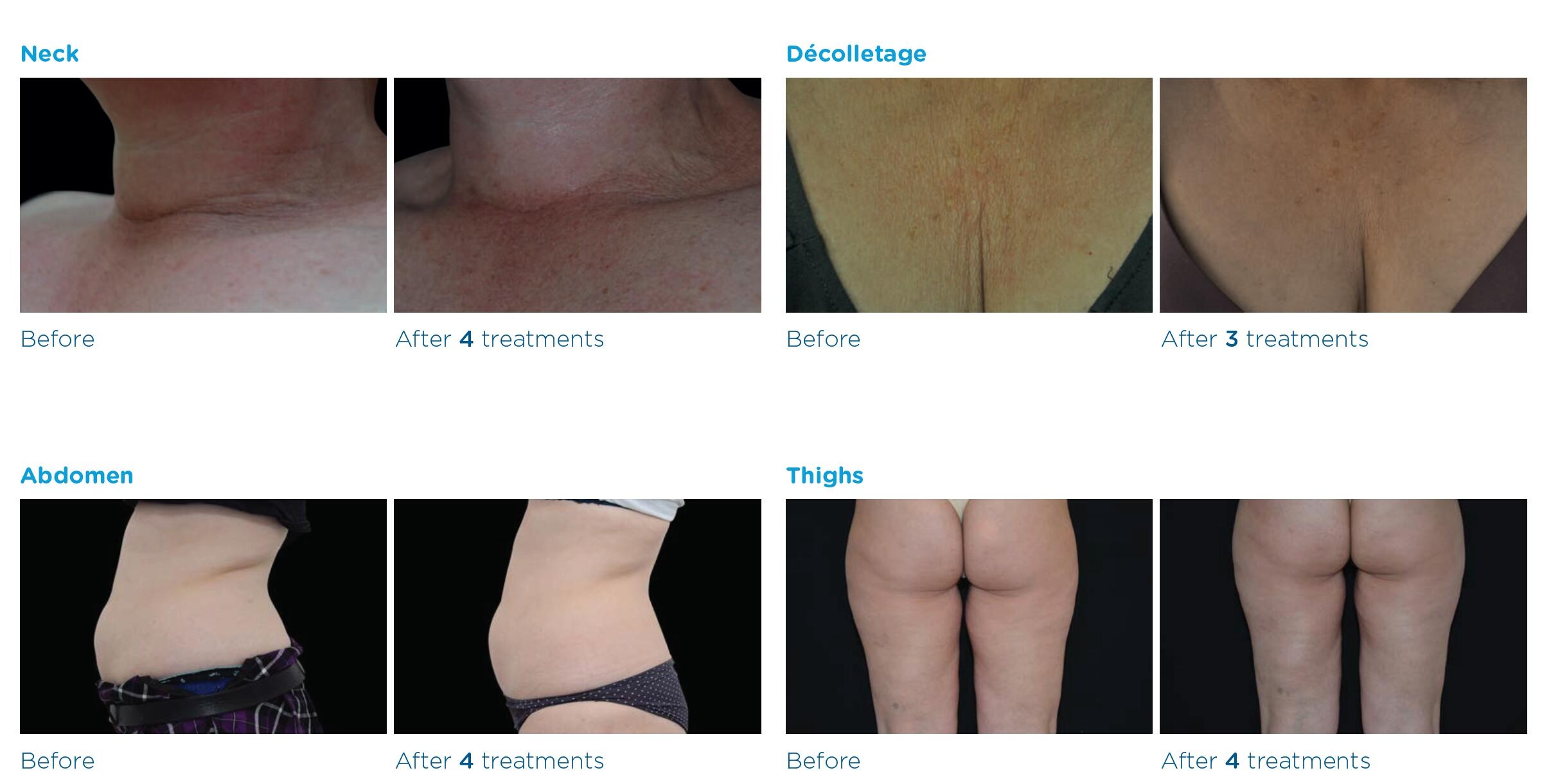 Exilis Elite fat reduction