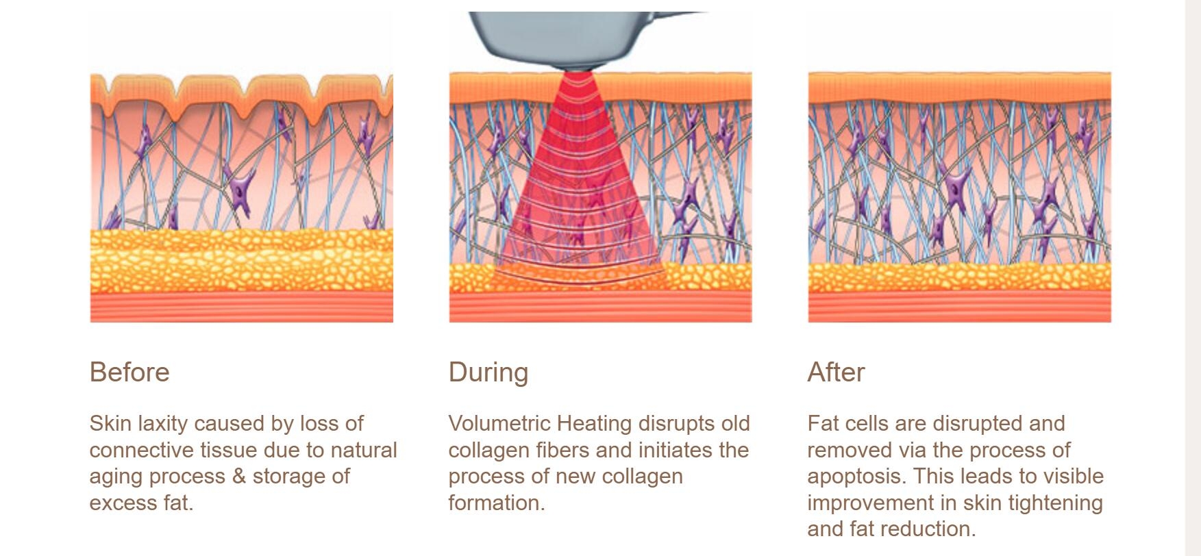 RF skin tightening