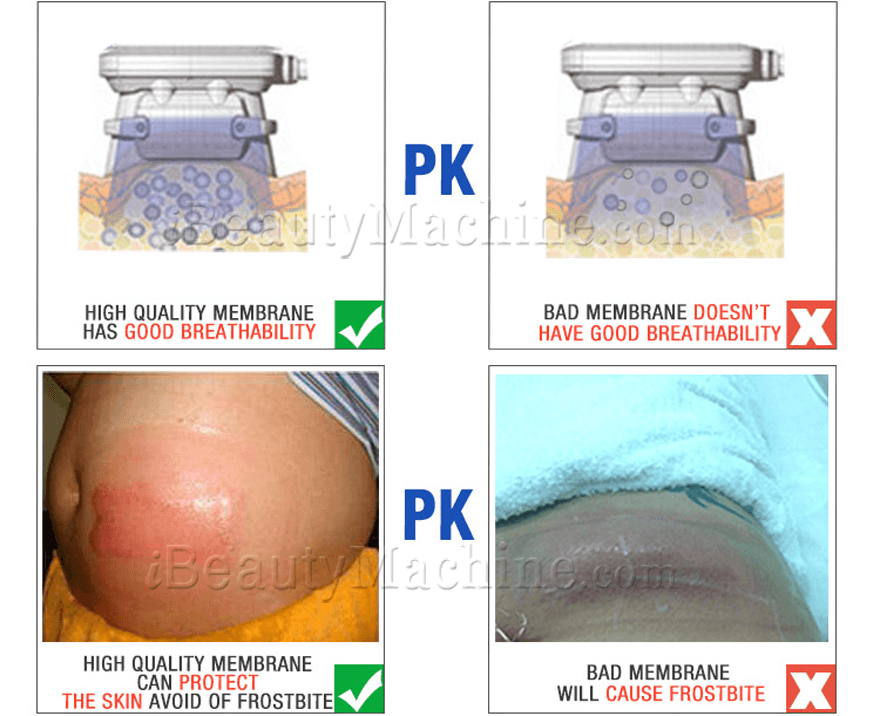 Back Body Shaper Anti Freezing Membrane For Cryolipolysis, For Clinical  Purpose at Rs 200/piece in Noida