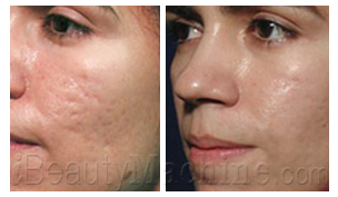 Acne scars removal BA photos